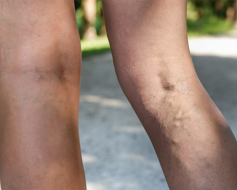 What should I do to prevent varicose veins from coming back? Vein